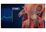 create 3d cardiovascular medical device animation, stent and catheter explainer